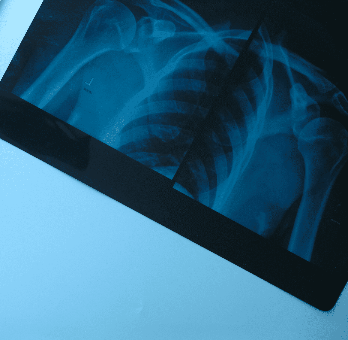 x ray image for banner photo on personal injury page